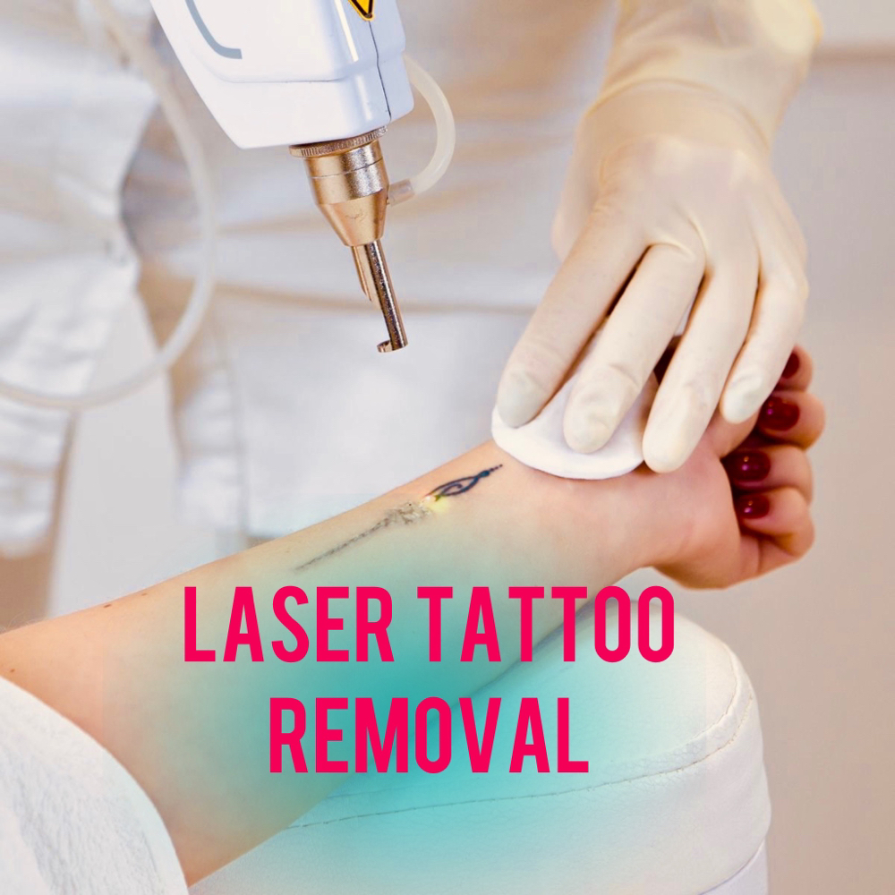 Laser Tattoo Removal