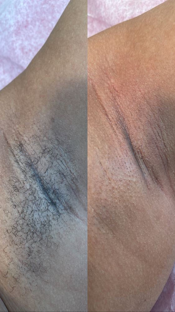Underarm Wax