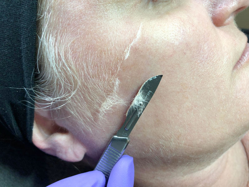 Dermaplaning