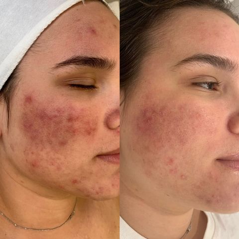 Acne Lift at Genie of Skin in Mooresville, NC