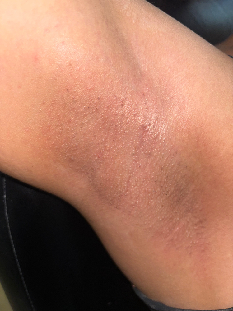 Underarm Wax at Glogetteresthetics in Warwick, RI