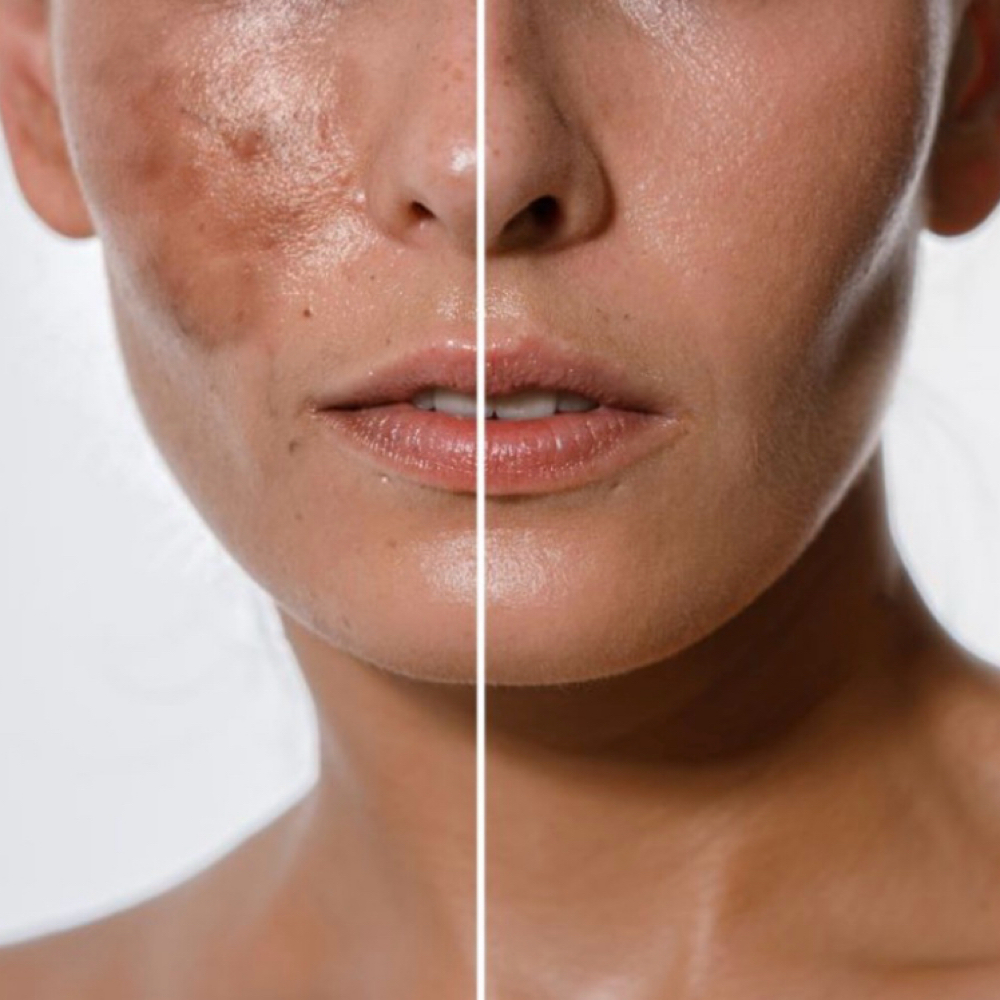Chemical Peel at Sacred Glow Studio in Milwaukee, WI