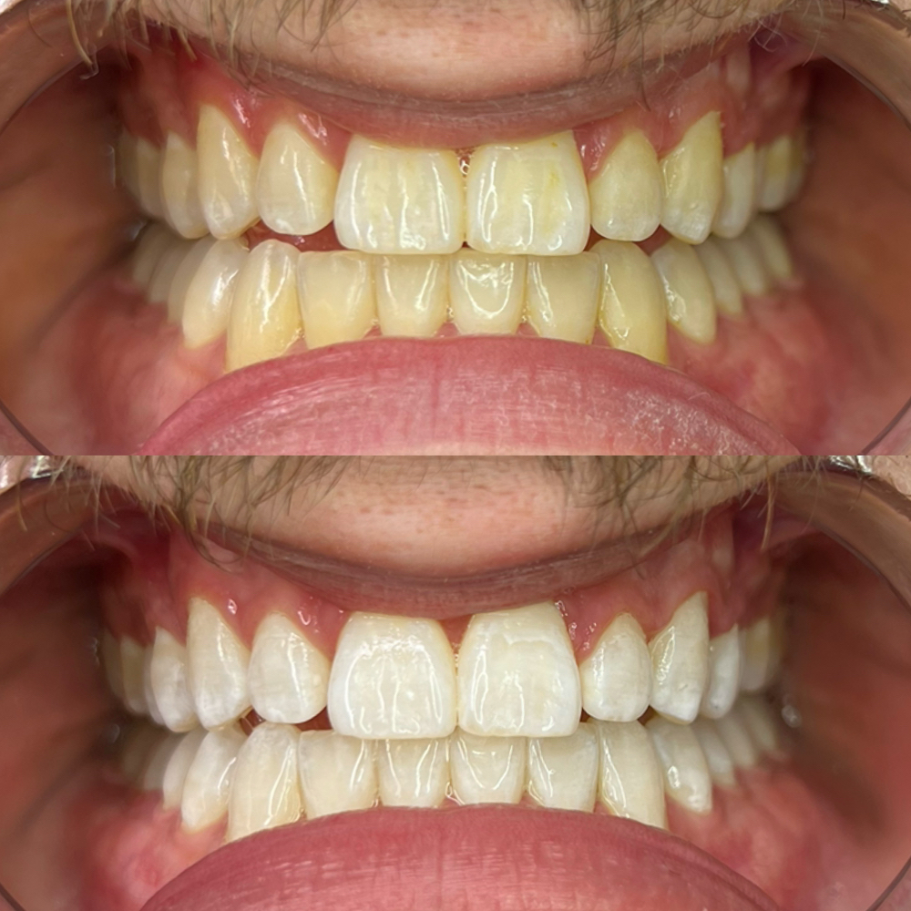 Teeth Whitening