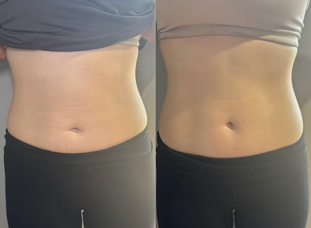 Cavitation Body Contouring