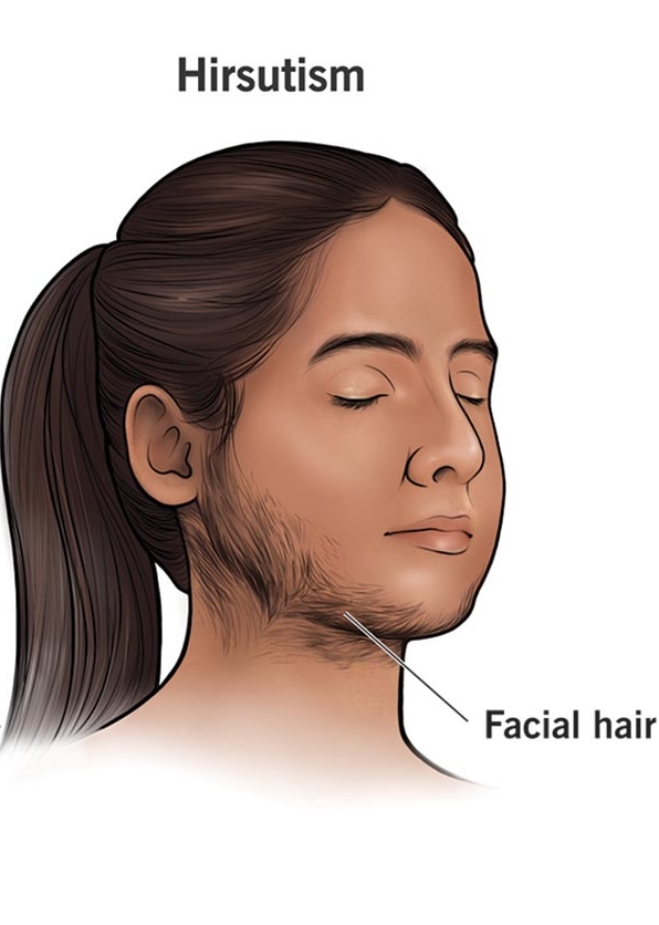  PCOS/HIRSUTISM FOLLICE FOCUS at MONMOUTH COUNTYᴺᴶ ✧ 1ST TOOTH JEWELER ↯ #POPURWAXINCHERRY in Hazlet, NJ