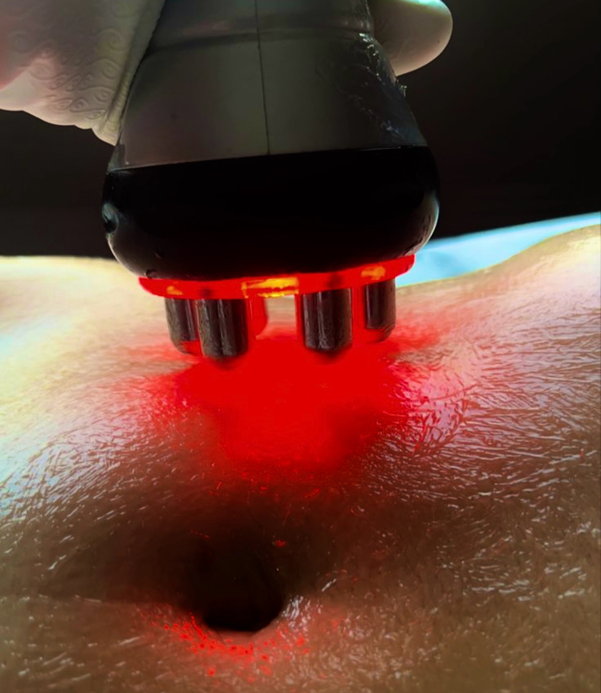 Ultrasonic Cavitation+Laser Lipo (stomach&back)