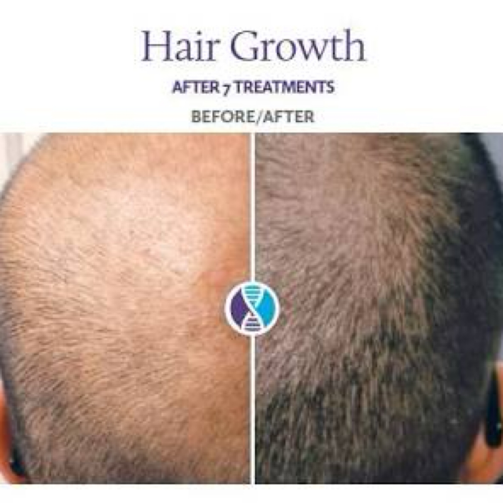 Procell Hair Restoration at Ah, Love The Skin You're In in Flower Mound, TX