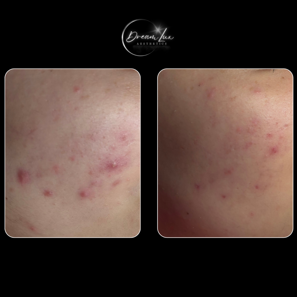 Acne Facial