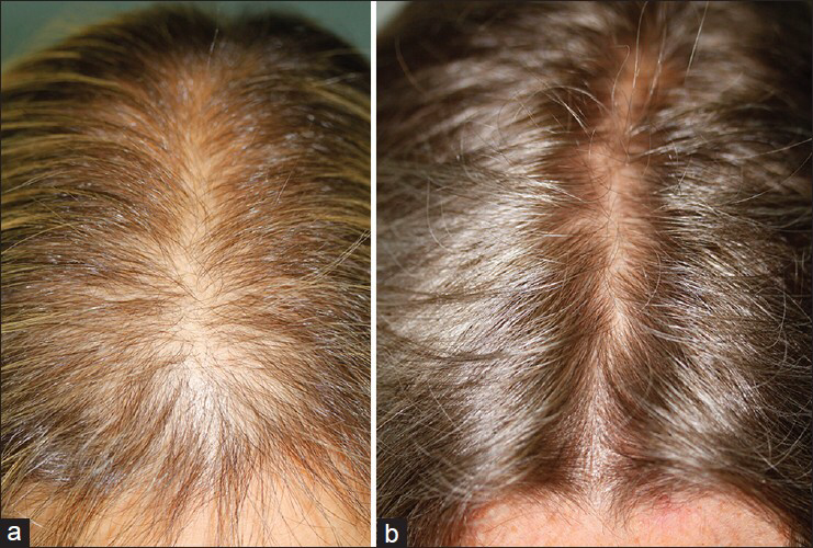 Hair Growth/Density Treatment