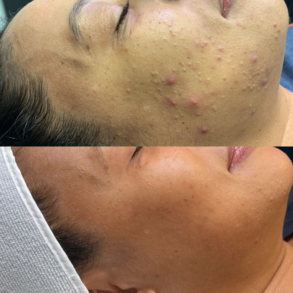 Clear Skin Facial