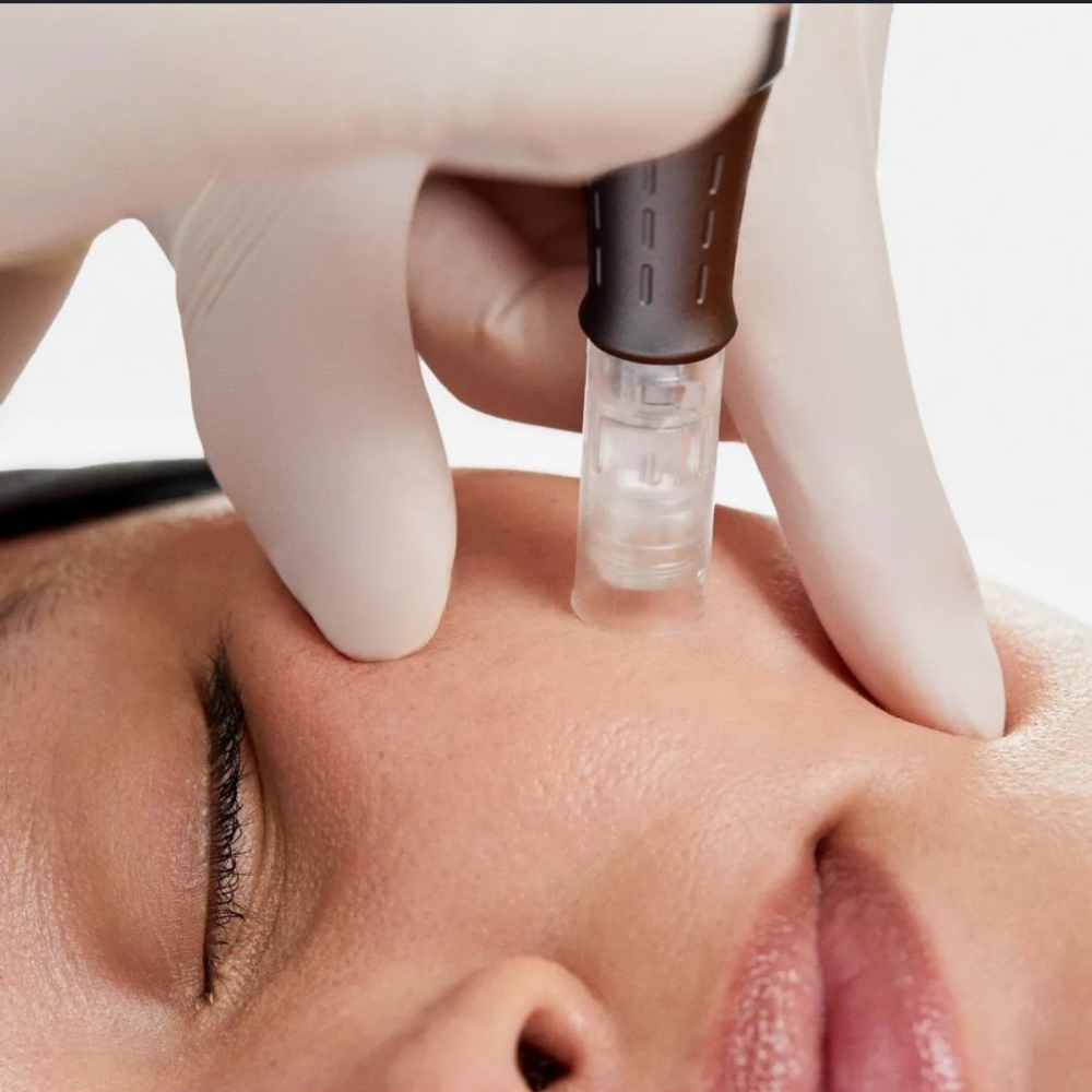 Micro Nano Needling at Luten&Co Beauty Studio in Woodland Hills, CA