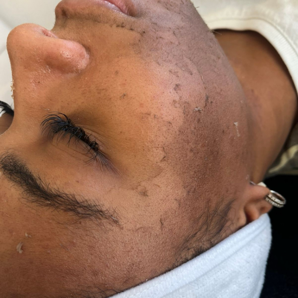 Hyperpigmentation Peel at The Pink Room Studio in Huntsville, AL