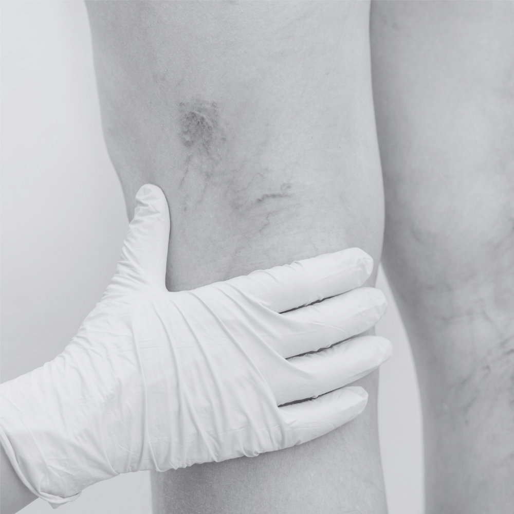 Vein Laser Reduction-Small Area at Kietre Wellness & Aesthetics in North Las Vegas, NV