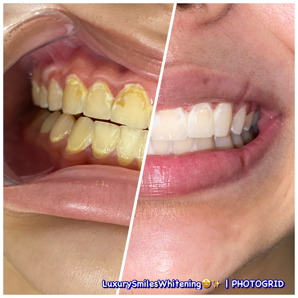 Teeth Whitening at Luxury Smiles, Waxes & More in Dallas, TX