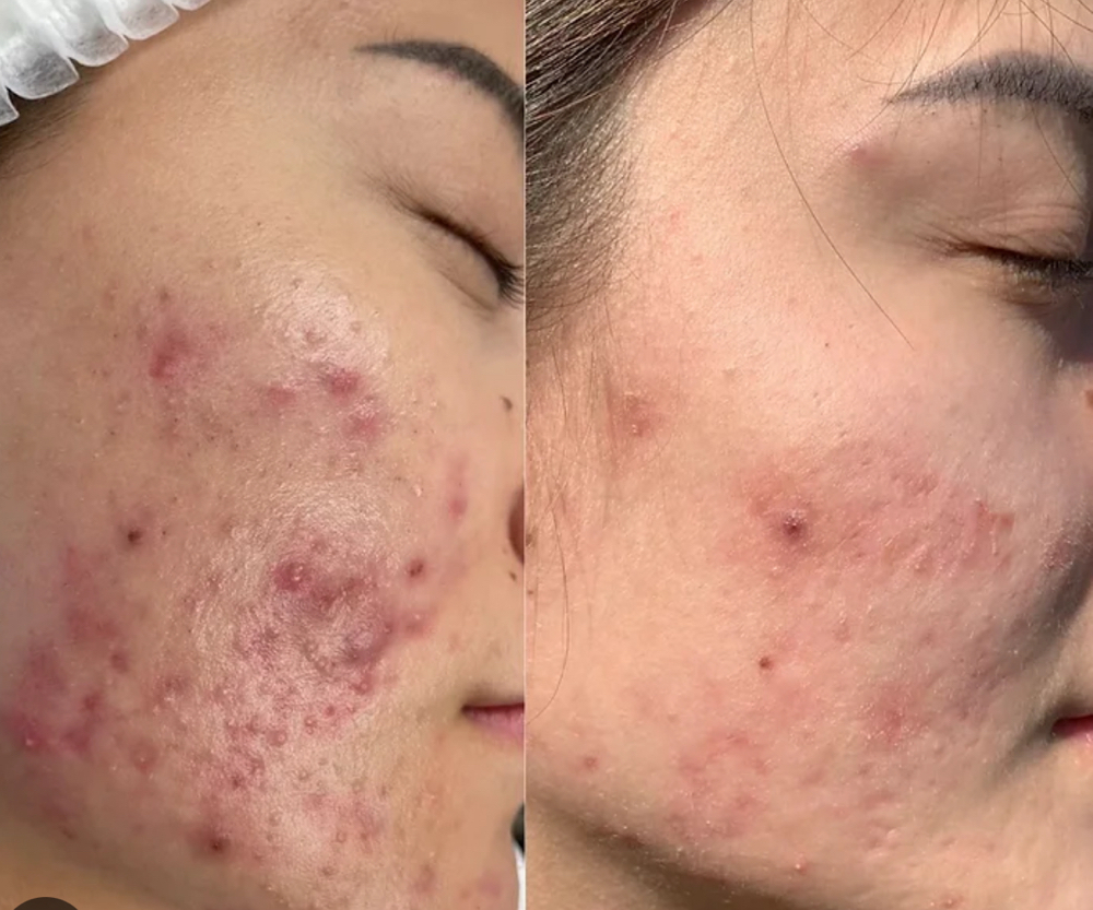 Acne Treatment Facial