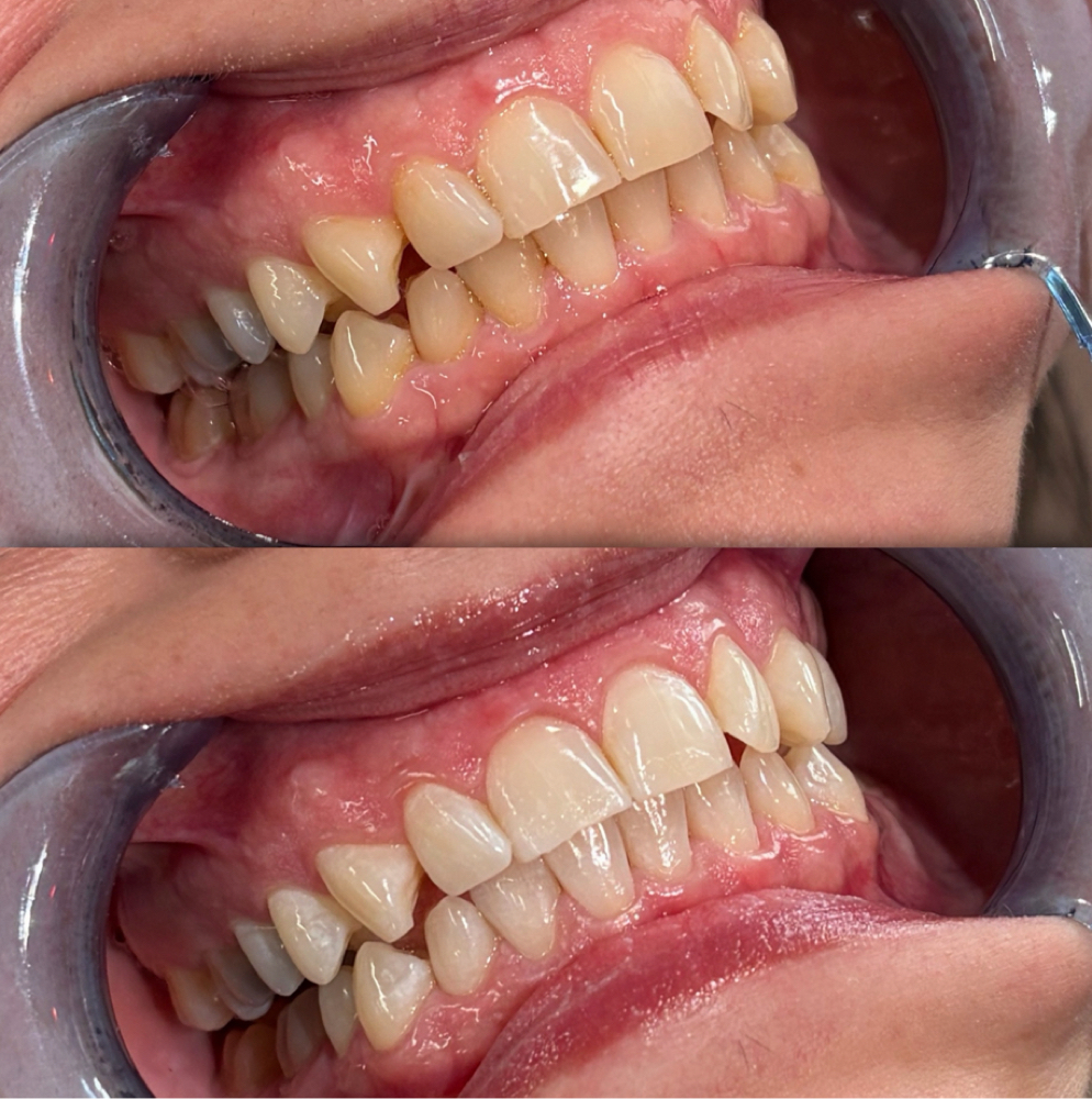 Teeth Whitening 30 min session at Waxed Culture in Olmos Park, TX