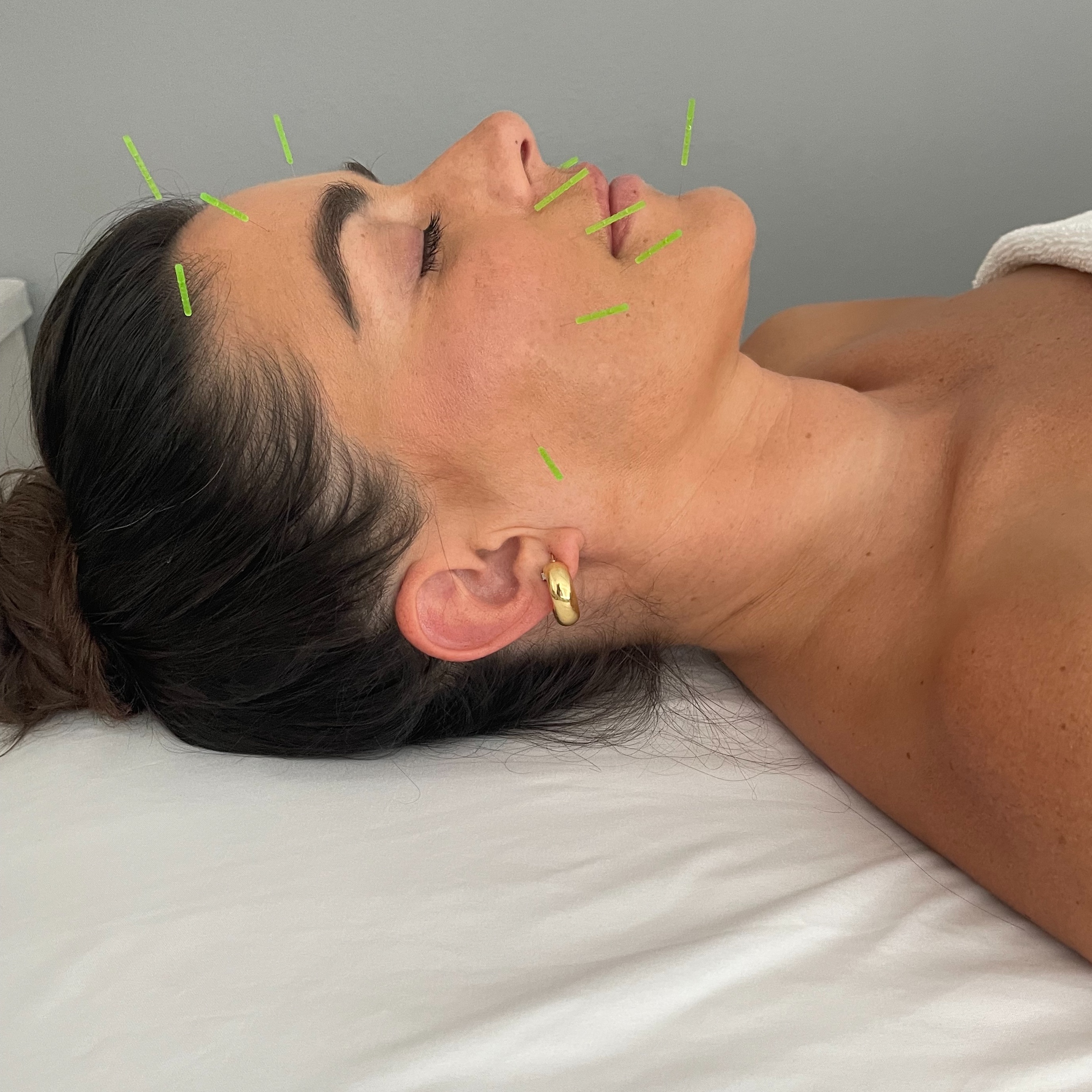 Follow-up Facial Acupuncture