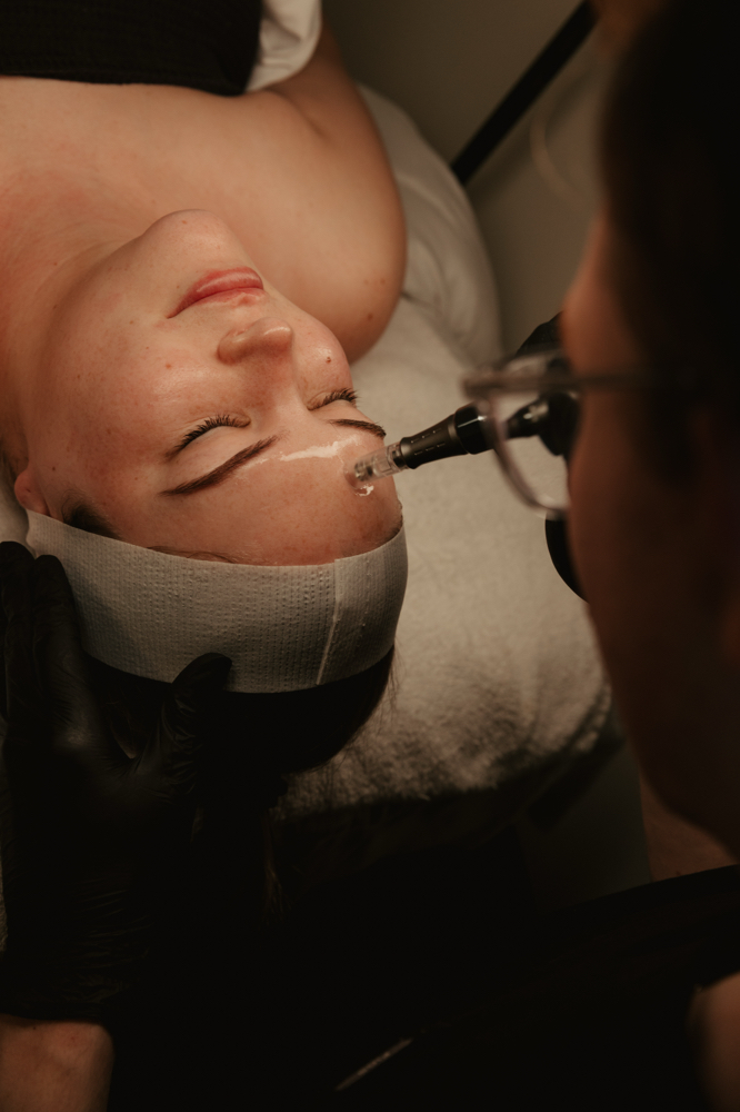 Microneedling Facial