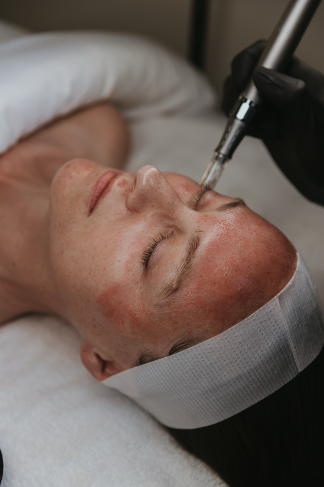 Microneedling Facial