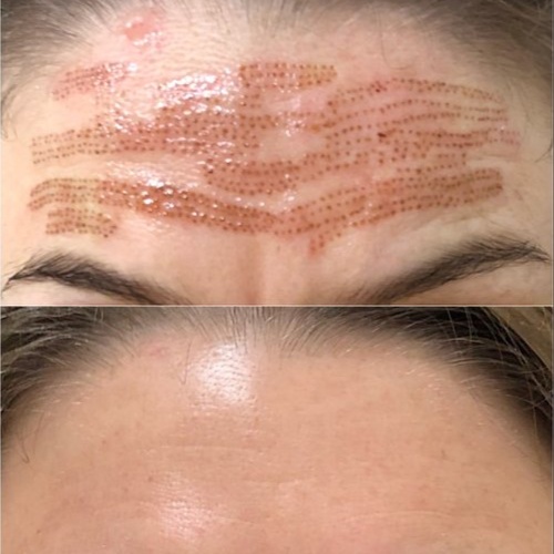Fibroblast (Forehead & Glabella) at Luscious Tox Aesthetics in Arlington, TX