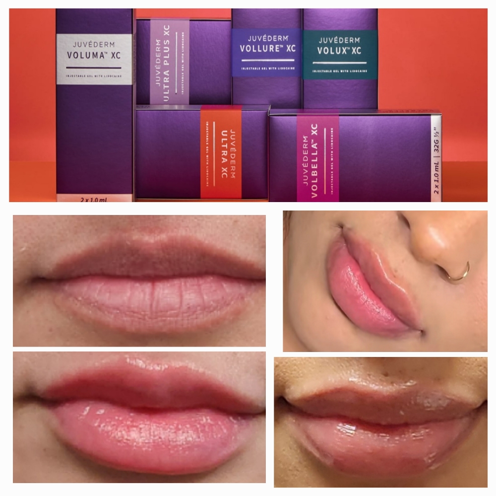Lip Filler