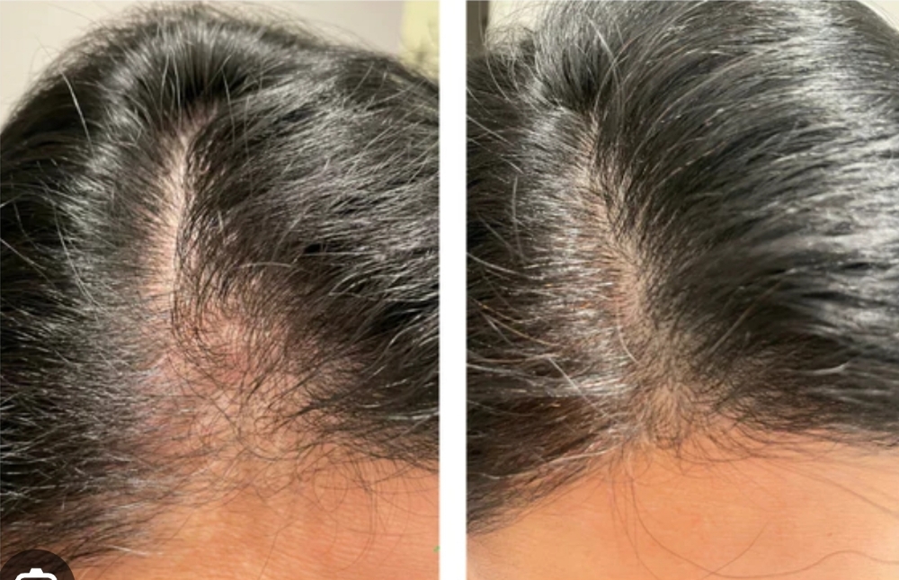 Hair Growth Treatment