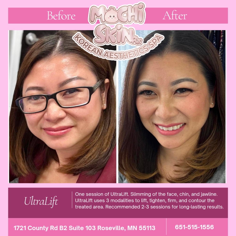 UltraLift (FACE ONLY- JULY PROMO) at Mochi Skin Rx in Roseville, MN