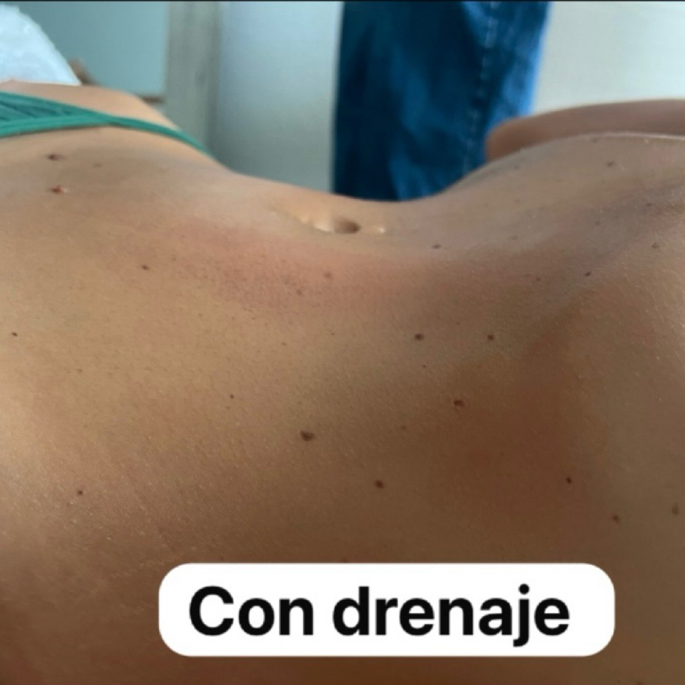 Lymphatic Drenage Massage at SiempreBellasBeautySpa in North Miami, FL