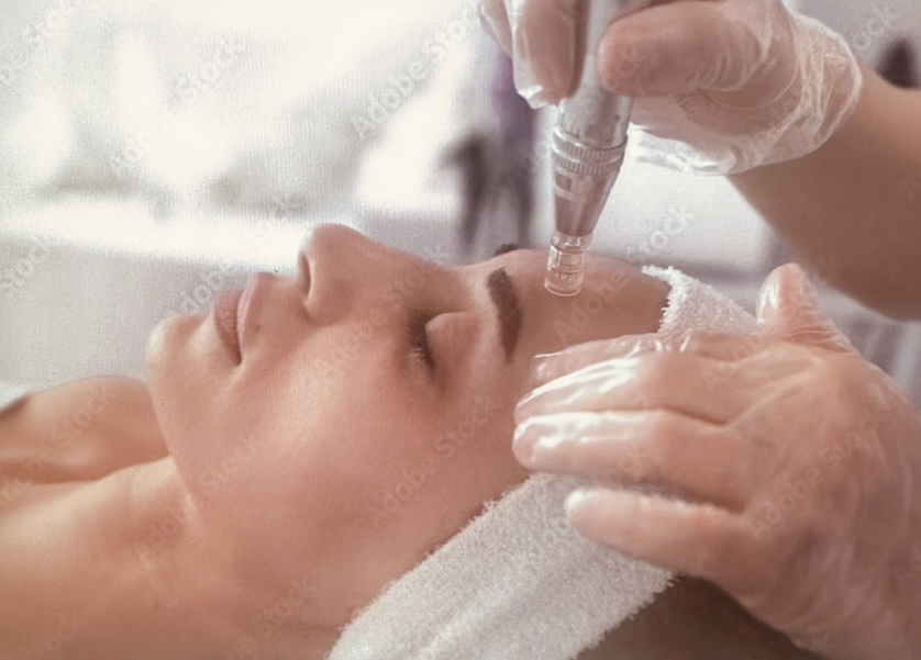 Microneedling