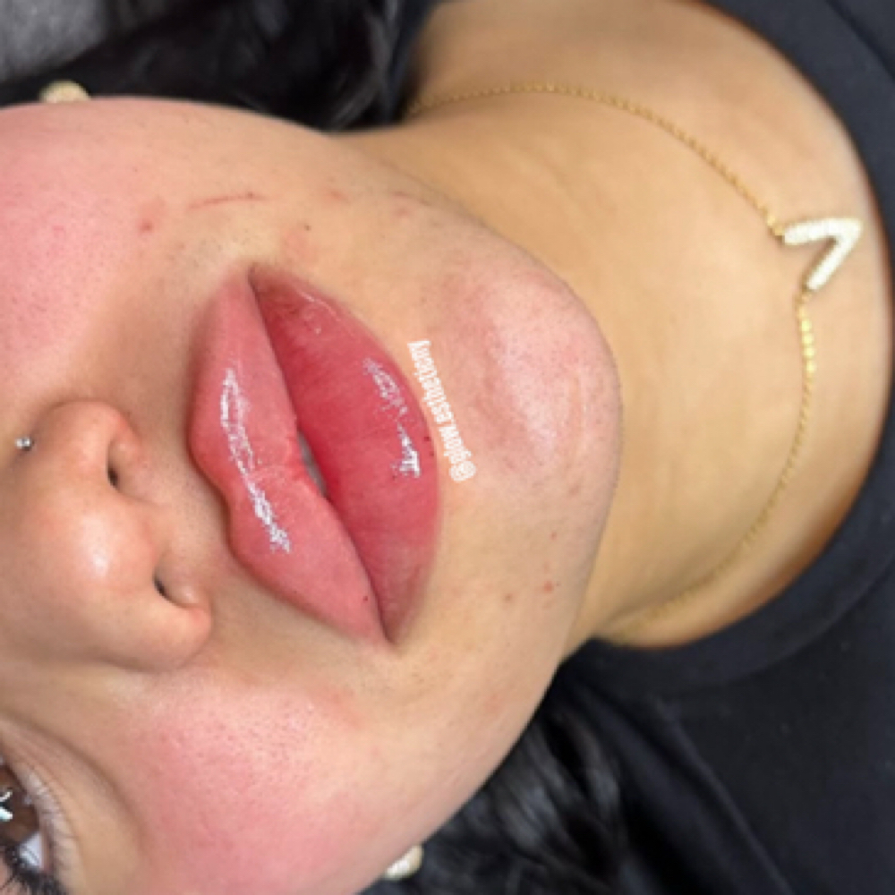2ml Lip Filler at Glow Esthetic NY in Buffalo, NY