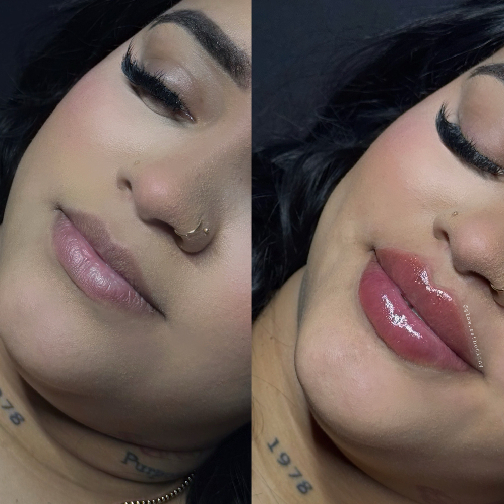 2ml Lip Filler
