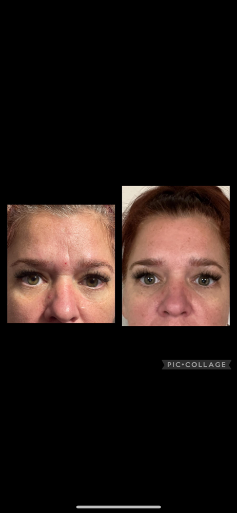 Botox Consult