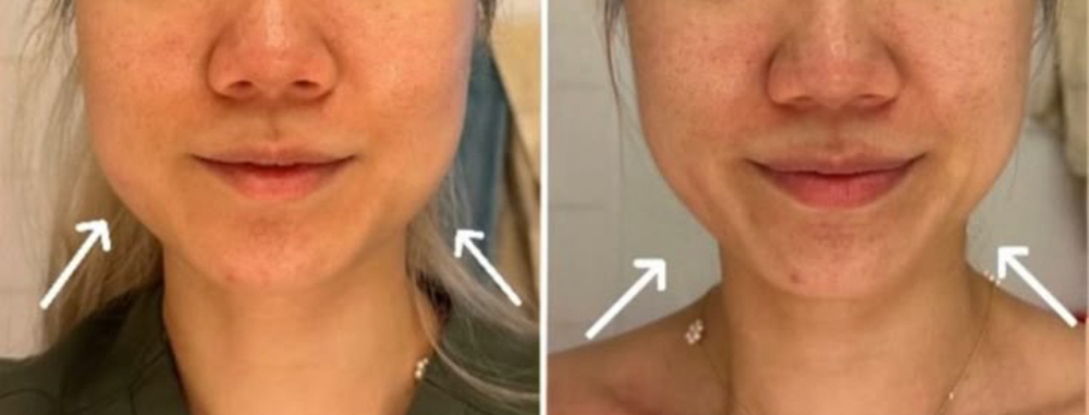 Tension Tamer: Masseter Botox