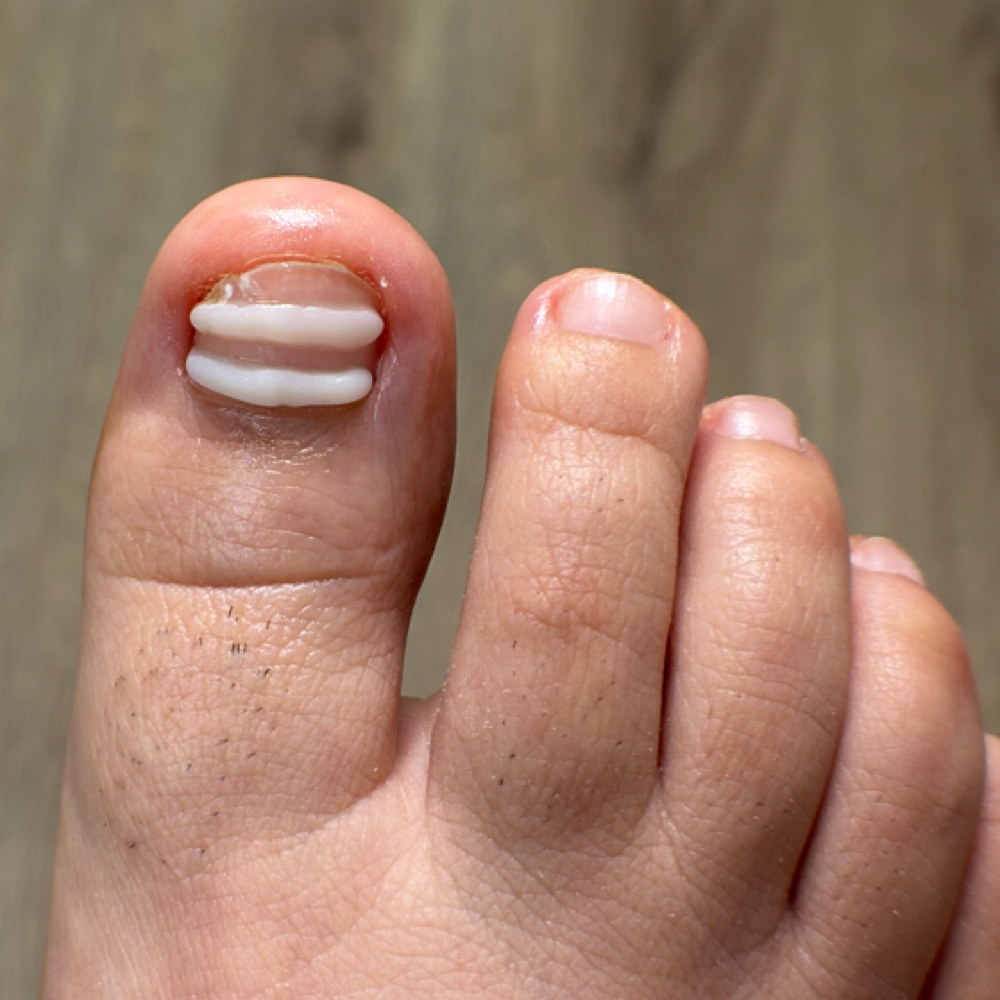 Ingrown Toenail Relief- 2+ Toes at Pure Nail Studio in Port Hueneme, CA