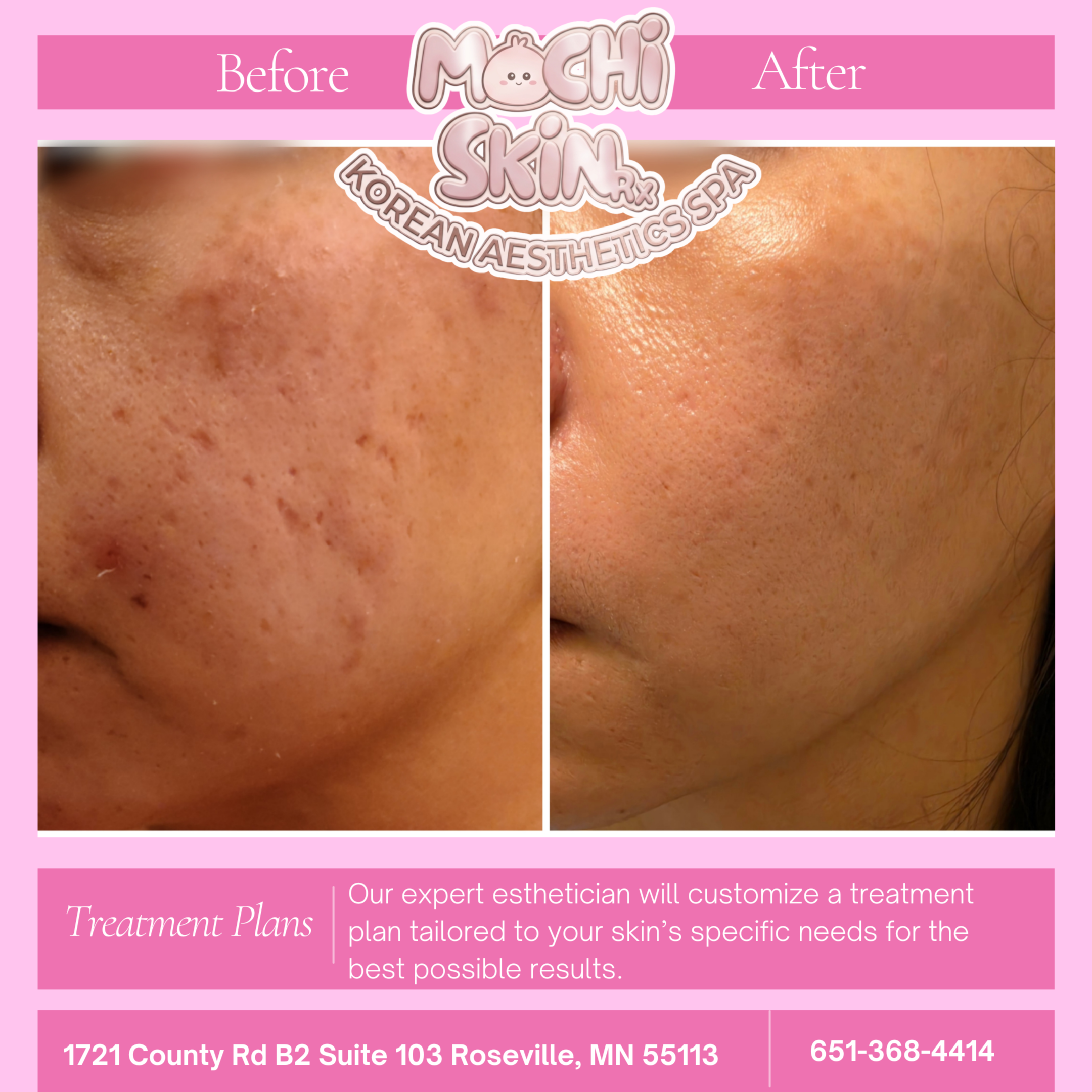 Korean Multi-Facial at Mochi Skin Rx in Roseville, MN