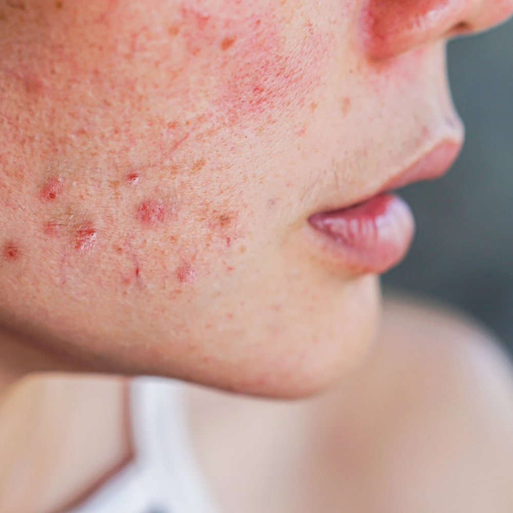 Acne Treatment Only (in Clinic)