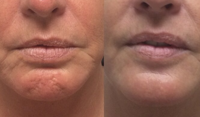 chin tox at Injector Lucia in San Juan, TX