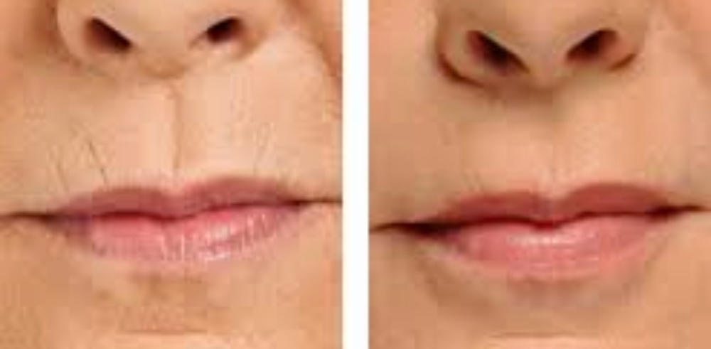 Botox Lip Lines