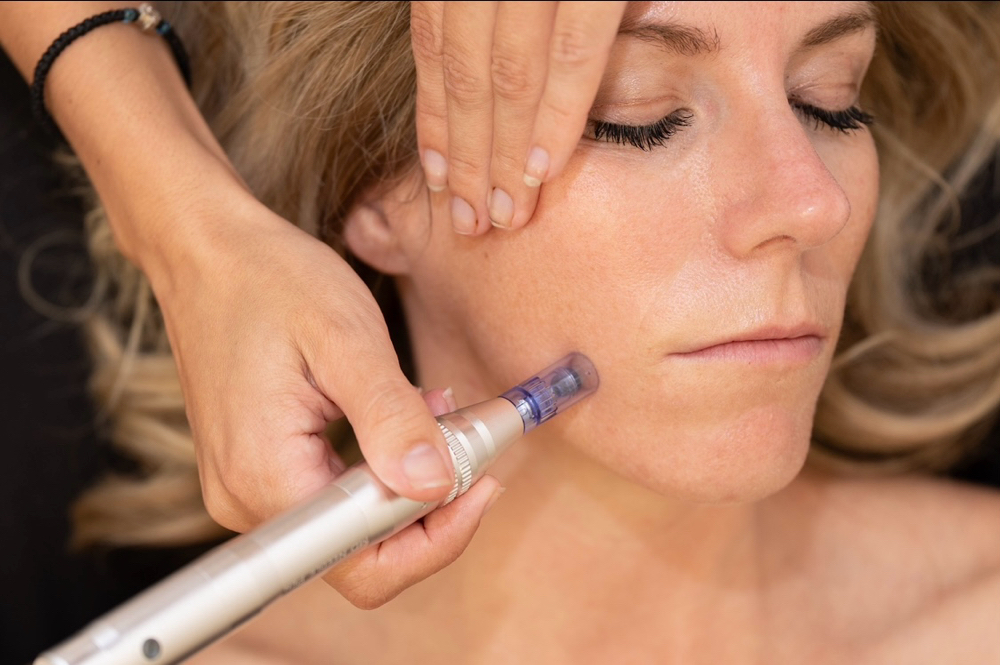 Microneedling