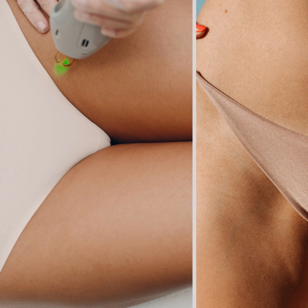 Bikini Line Laser- One Session Only at SLS Laser Medspa in Ontario, CA