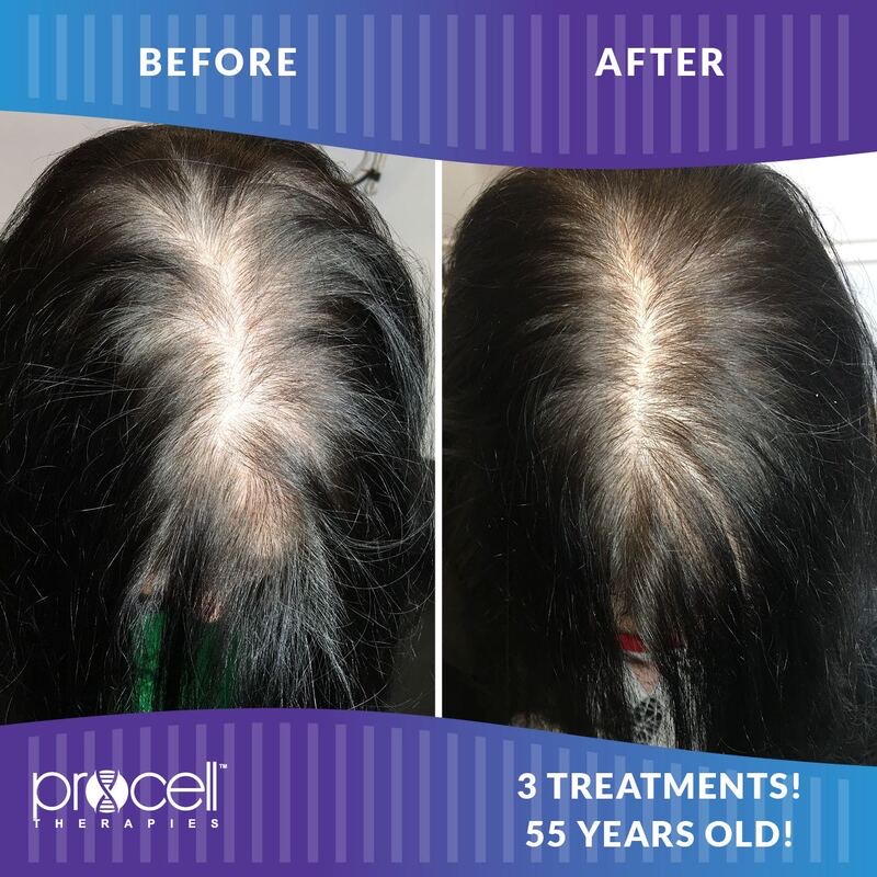 ProCell Therapies Hair Regeneration