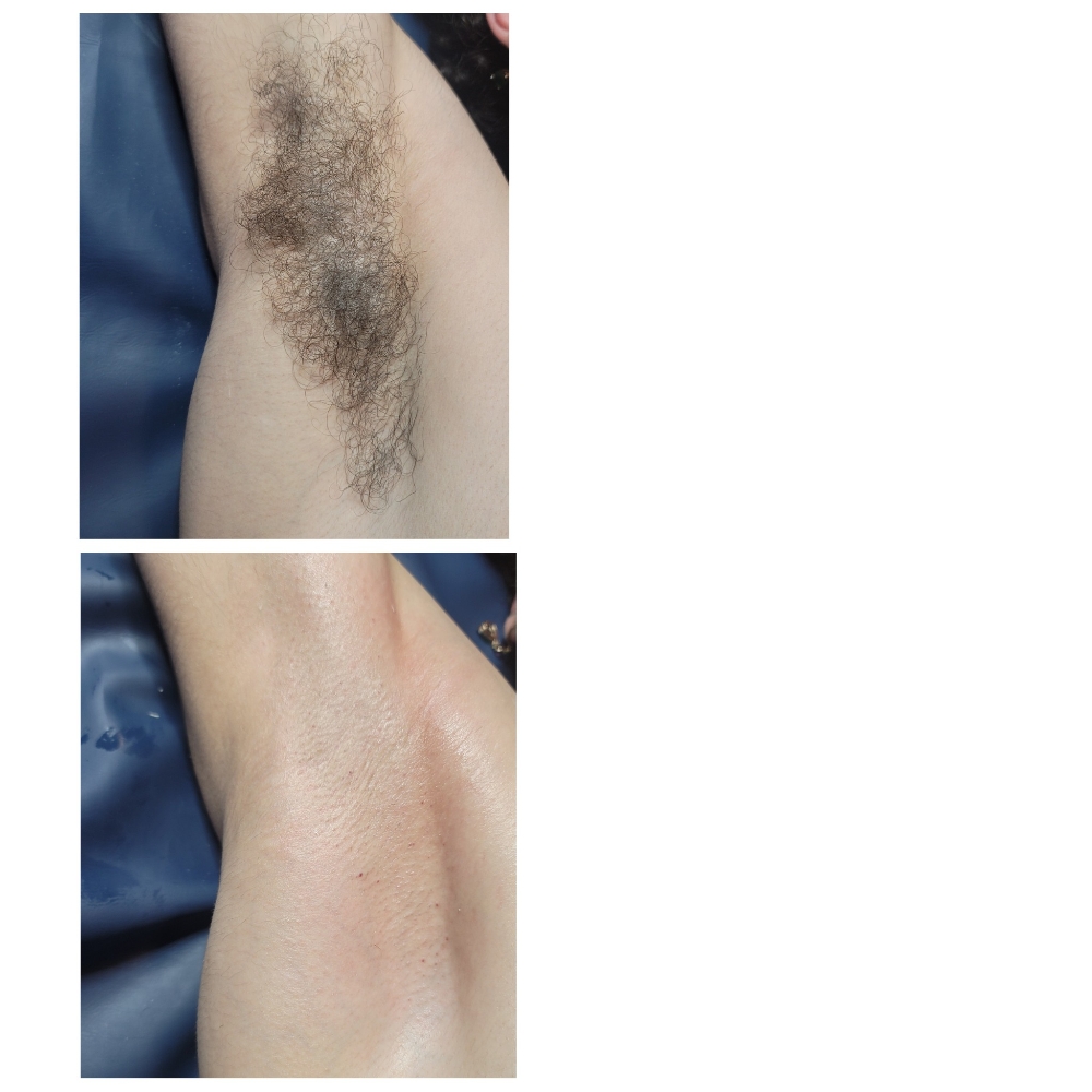 Underarm