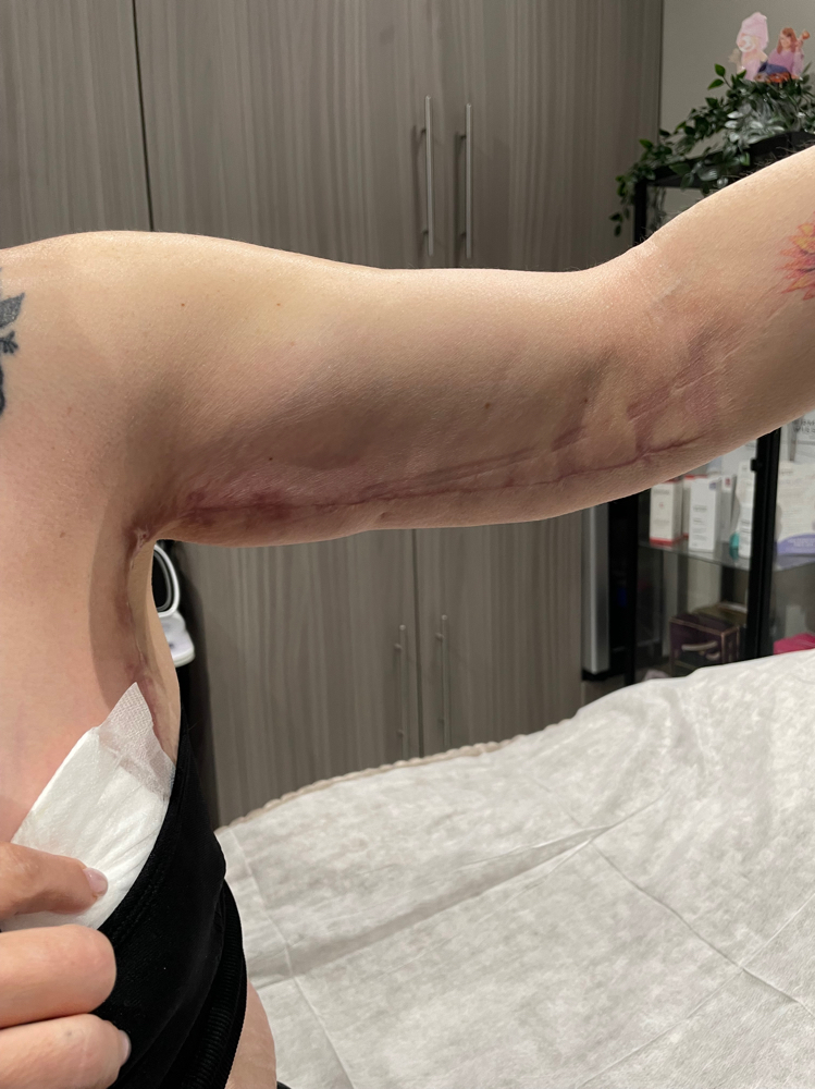 Post Op For Arms (10 Sections)