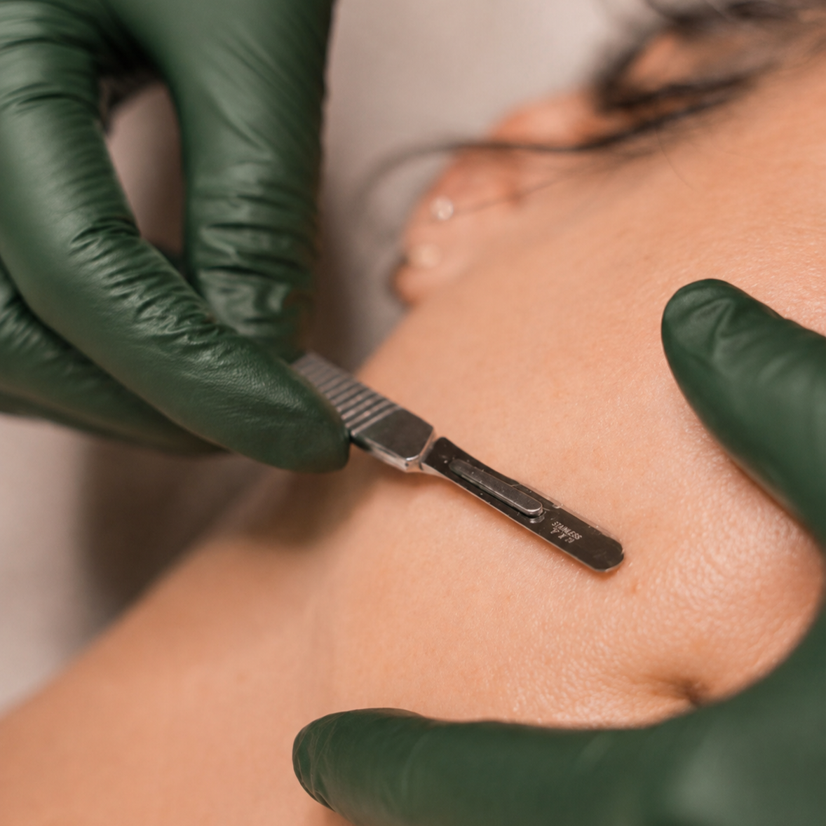 Dermaplaning Facial at Woods Body & Skin Therapy