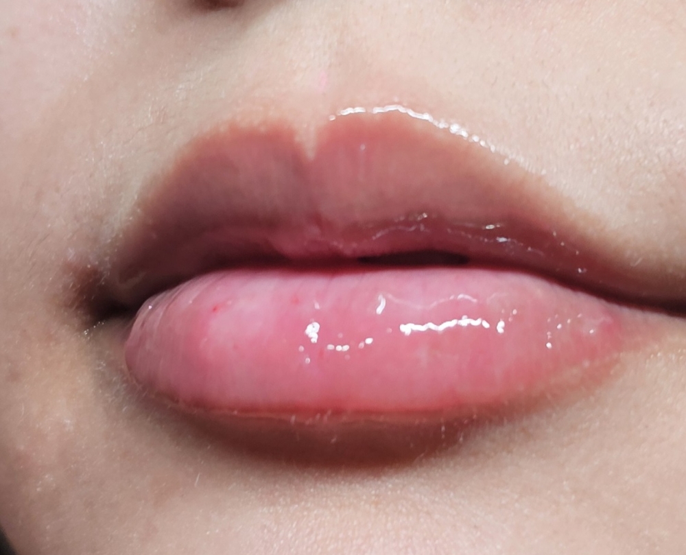 Labios, Reticulado 2ml