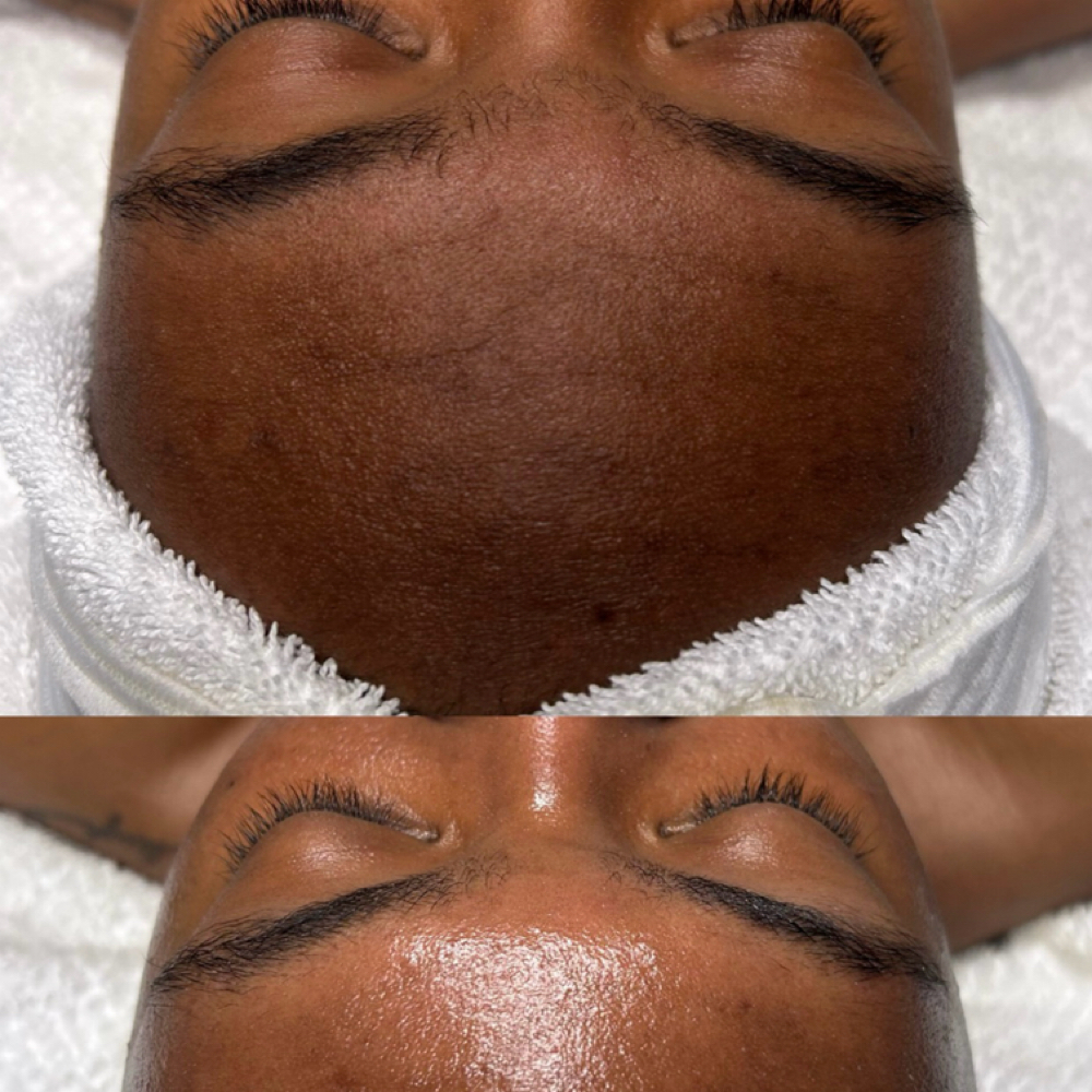 Microchannel; Brightening/AntiAging at Beauty Therapy by Chanel in Tucker, GA