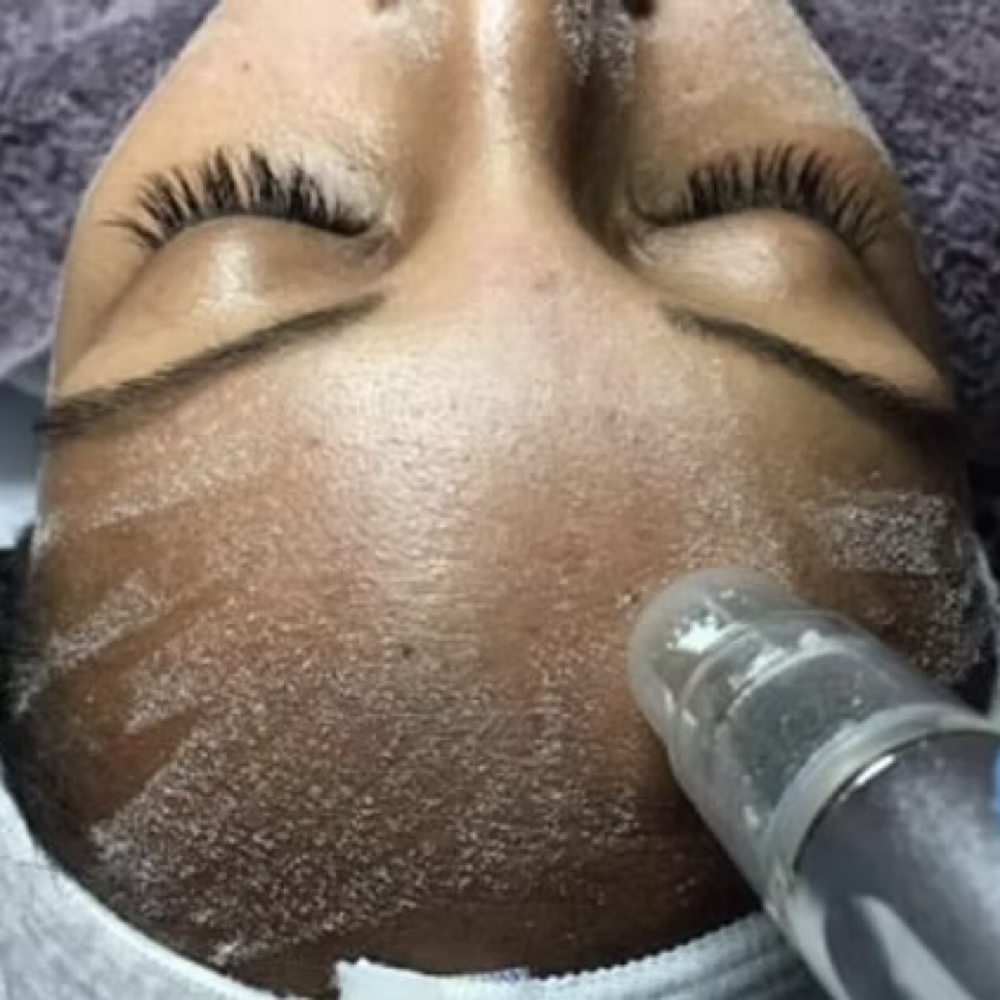 Crystal Microdermabrasion at Olivia Esthetics in Longview, TX