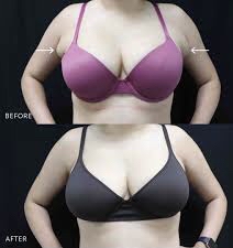 BRA FAT ~ Front Bulge