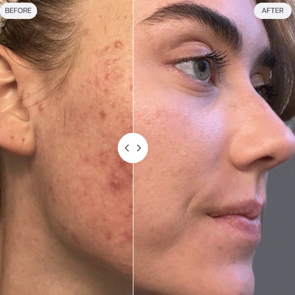 Acne Facial at Vibe Skin Lab in Woburn, MA