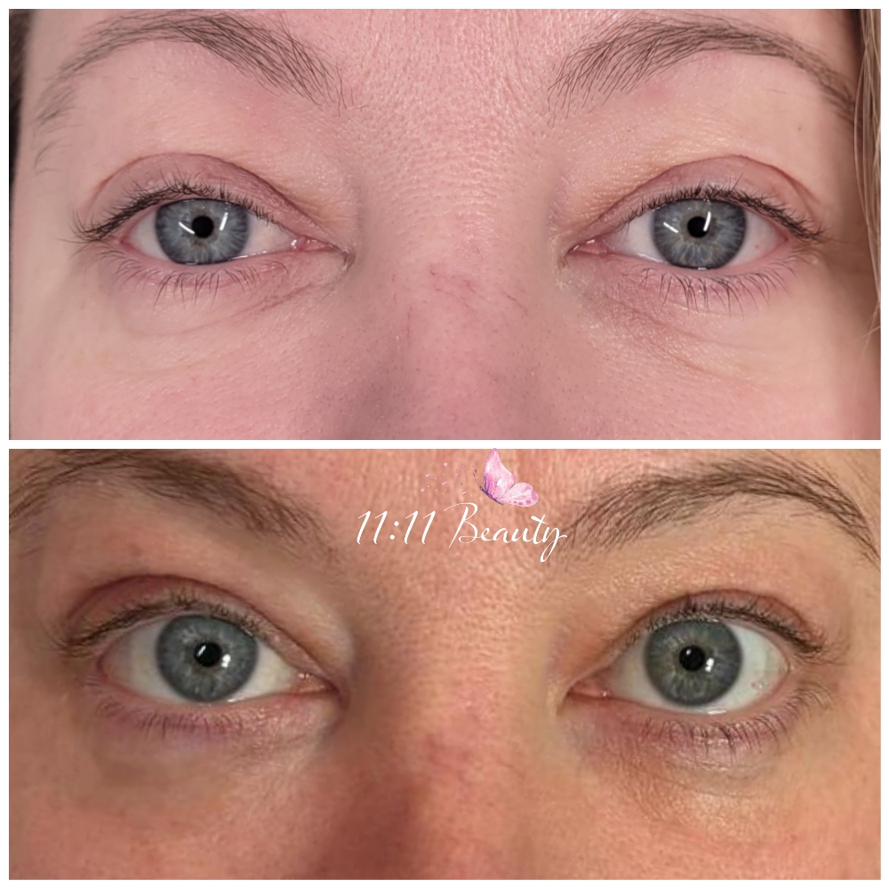 Upper And Lower Lids